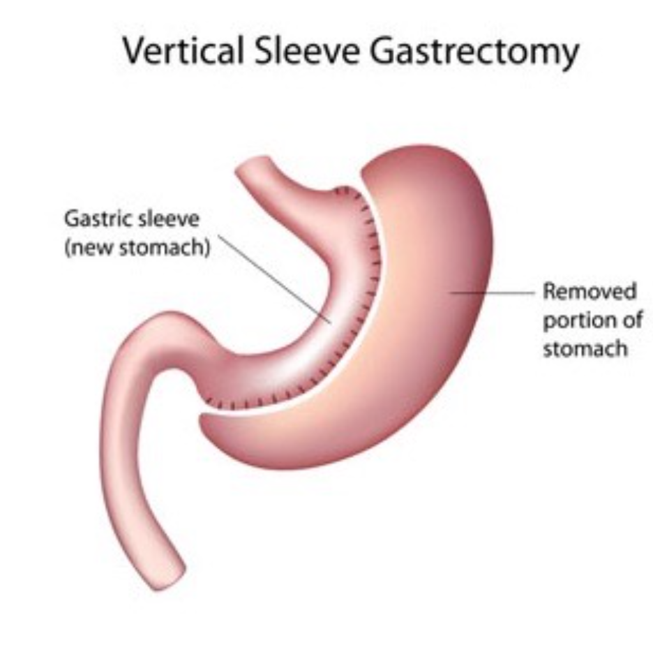 Gastric Sleeve Surgery