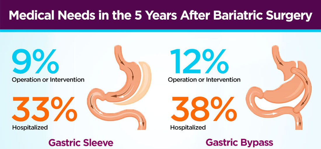 Understanding The Common Gastric Sleeve Complications - The