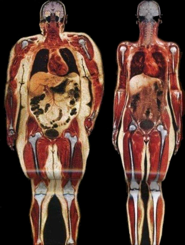 A visual comparison of how fat affects the human anatomy